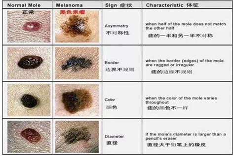 身上有很多痣|你身上的痣会癌变吗？医生分析了100多颗黑痣，快来。